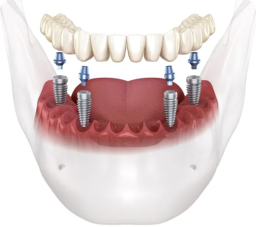All On X dental implant system