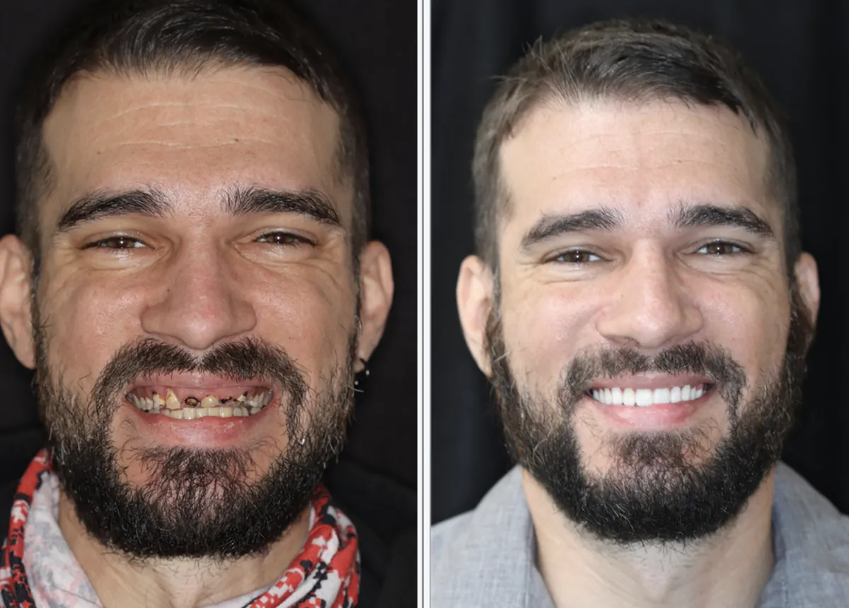 Patient before and after dental implants