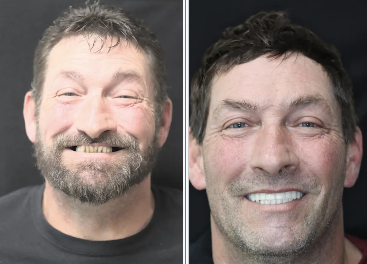 Patient before and after dental implants