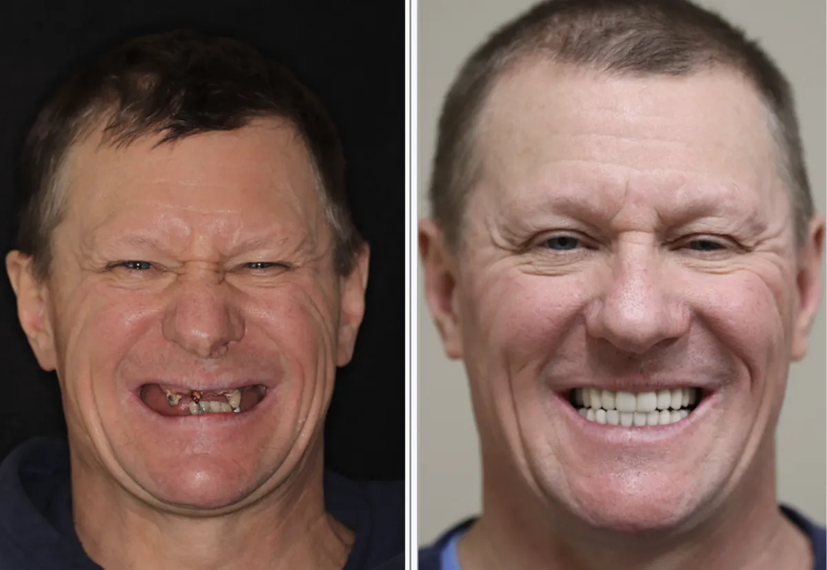 Patient before and after dental implants