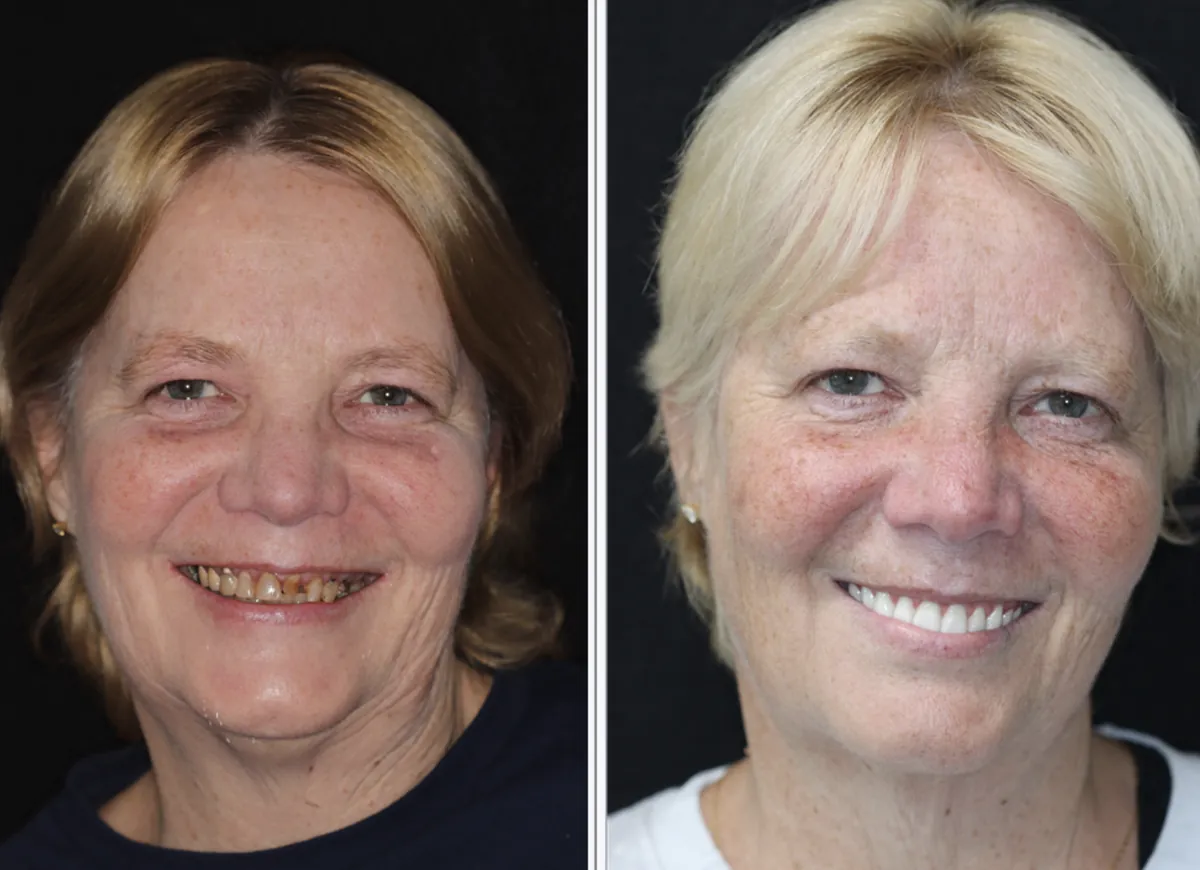 Patient before and after dental implants