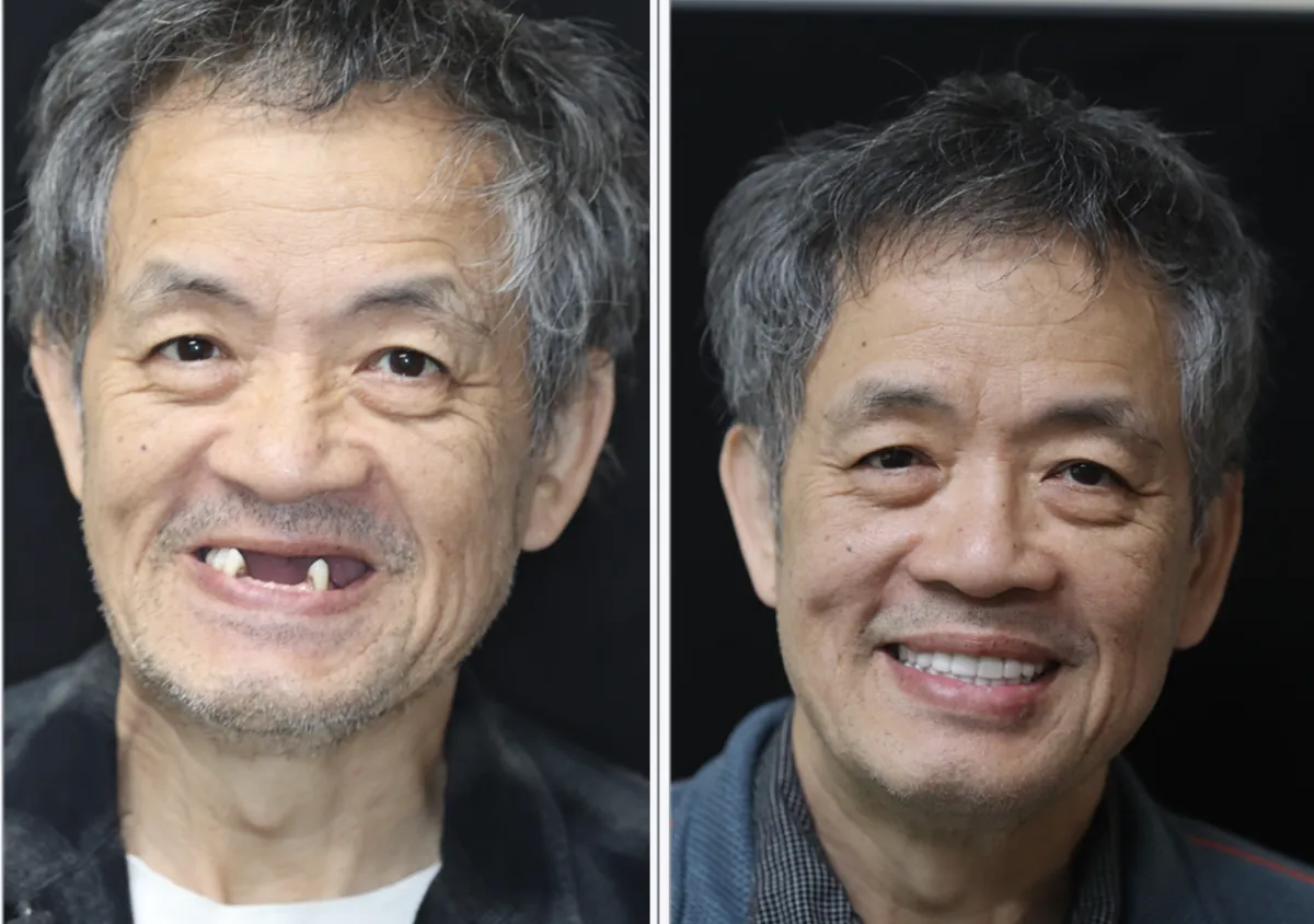 Patient before and after dental implants