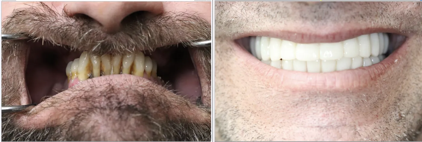 Patient before and after dental implants