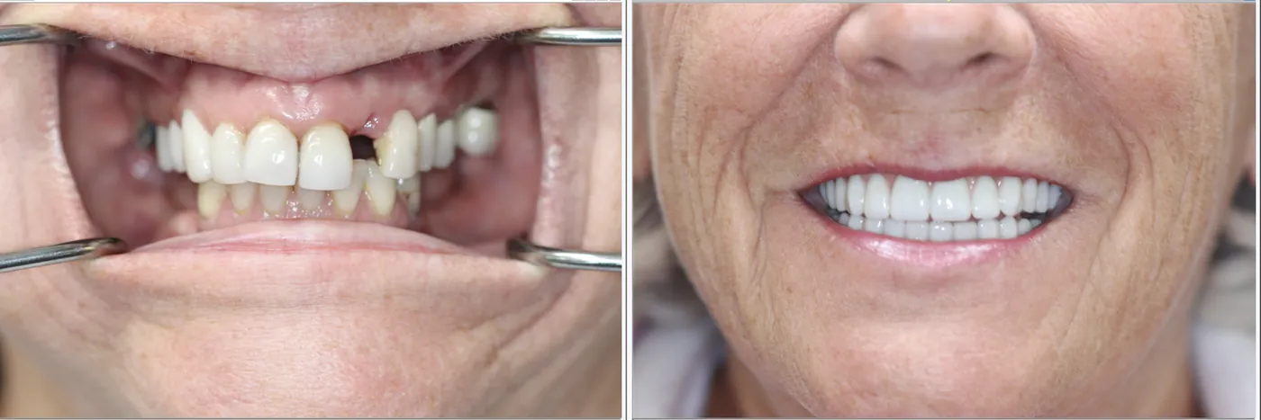 Patient before and after dental implants