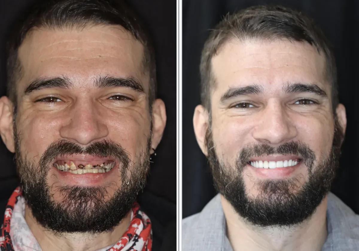Patient before and after dental implants