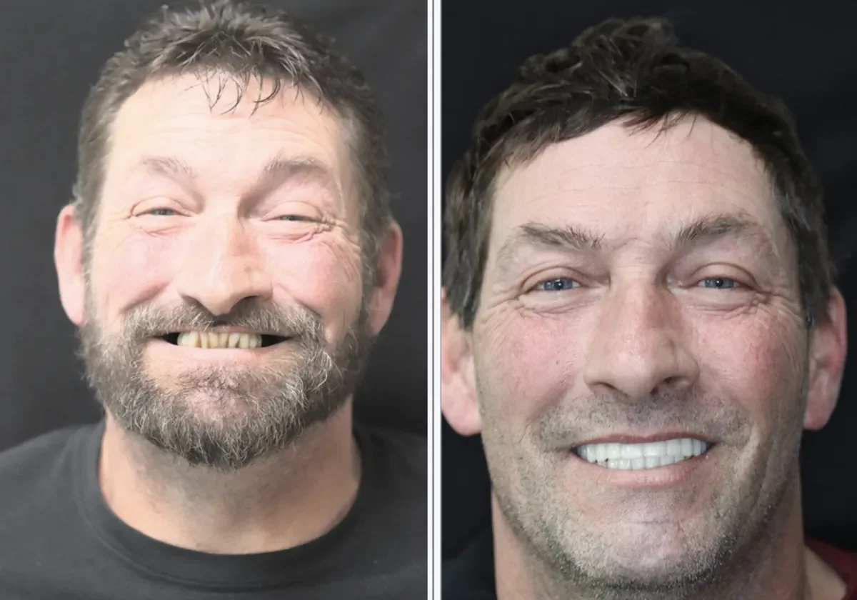 Patient before and after dental implants