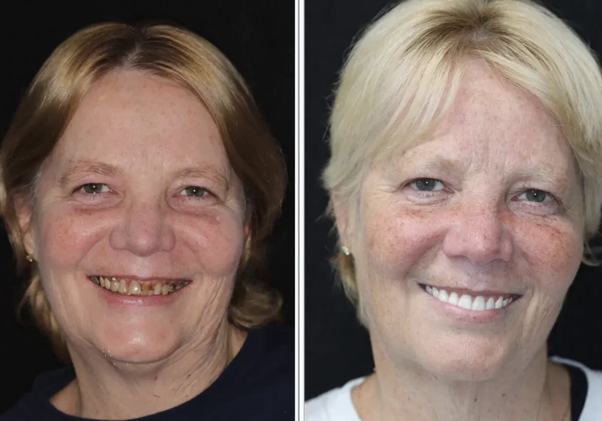 Patient before and after dental implants
