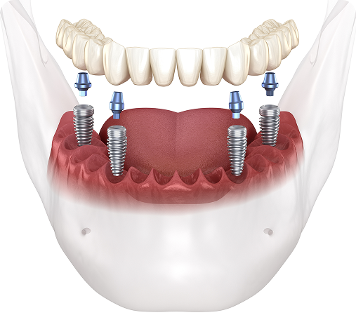 All on X / Full-Arch Restoration