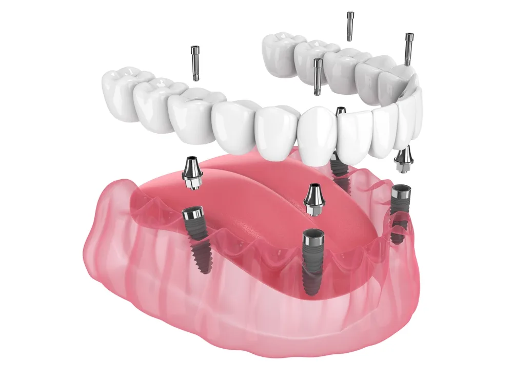 All-on-X Dental Implants