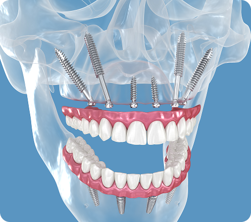 Zygomatic Implants